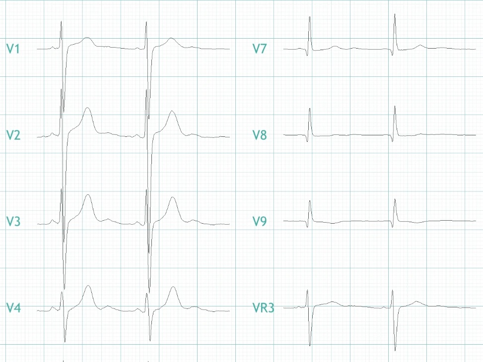 Ruhe-EKG mit Brustwandableitungen V1 bis V4 und Zusatzableitungen V7 bis V9 und VR3 (Ausschnitt)